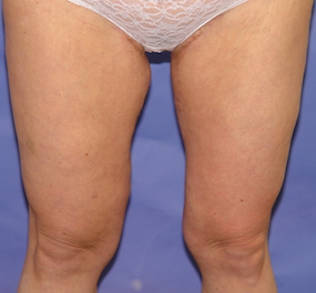 Thigh Lift Before & After Patient #2446