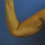 Arm Lift Before & After Patient #2595