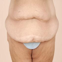 Body Lift Before & After Patient #2424