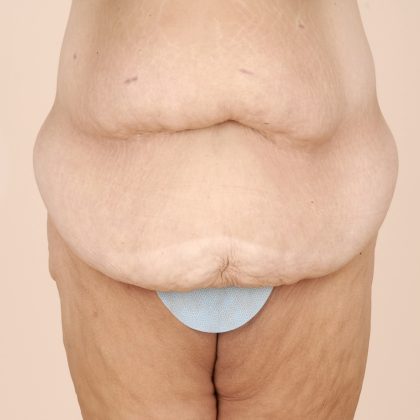 Body Lift Before & After Patient #2424