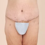 Body Lift Before & After Patient #2424