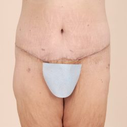 Body Lift Before & After Patient #2424