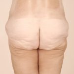 Body Lift Before & After Patient #2424