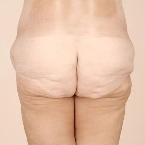 Body Lift Before & After Patient #2424