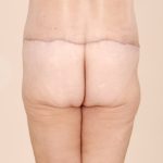 Body Lift Before & After Patient #2424