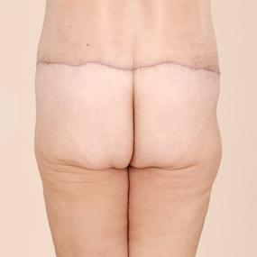 Body Lift Before & After Patient #2424