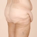 Body Lift Before & After Patient #2424