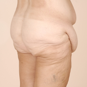 Body Lift Before & After Patient #2424