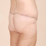 Body Lift Before & After Patient #2424