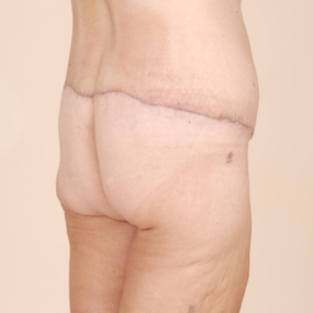 Body Lift Before & After Patient #2424
