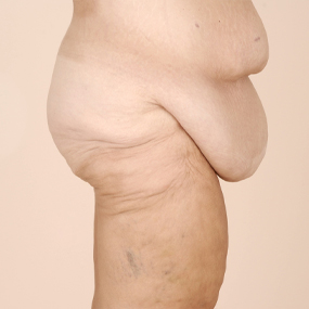 Body Lift Before & After Patient #2424