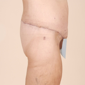 Body Lift Before & After Patient #2424
