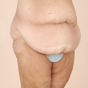 Body Lift Before & After Patient #2424