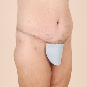 Body Lift Before & After Patient #2424