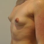 Breast Augmentation Before & After Patient #2455