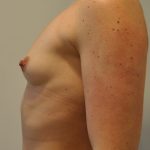 Breast Augmentation Before & After Patient #2455