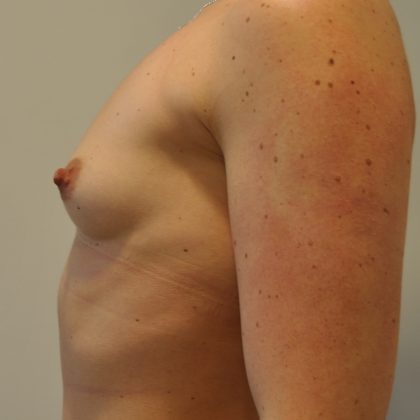 Breast Augmentation Before & After Patient #2455