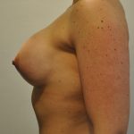 Breast Augmentation Before & After Patient #2455