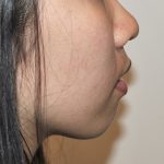 Chin Augmentation Before & After Patient #2306