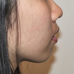Chin Augmentation Before & After Patient #2306