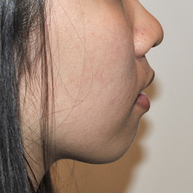 Chin Augmentation Before & After Patient #2306
