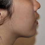 Chin Augmentation Before & After Patient #2306