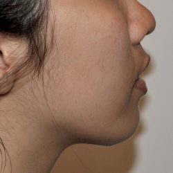 Chin Augmentation Before & After Patient #2306