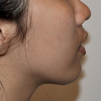 Chin Augmentation Before & After Patient #2306