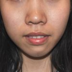 Chin Augmentation Before & After Patient #2306