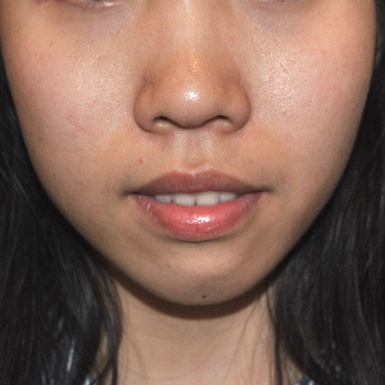 Chin Augmentation Before & After Patient #2306