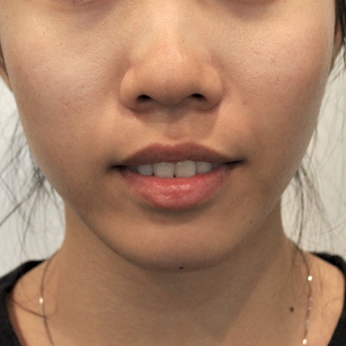 Chin Augmentation Before & After Patient #2306