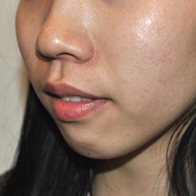 Chin Augmentation Before & After Patient #2306