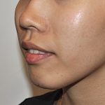 Chin Augmentation Before & After Patient #2306