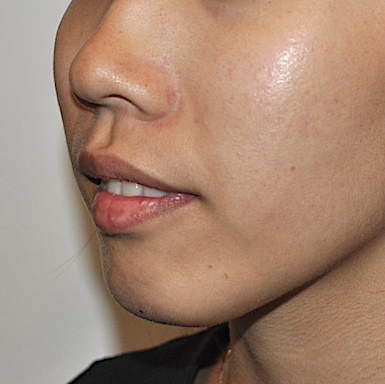 Chin Augmentation Before & After Patient #2306
