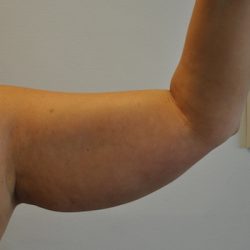 Liposuction Before & After Patient #2498