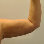 Liposuction Before & After Patient #2498