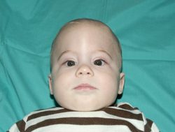 Pediatric Treatments Before & After Patient #2789
