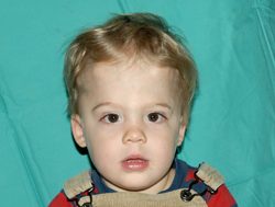 Pediatric Treatments Before & After Patient #2789