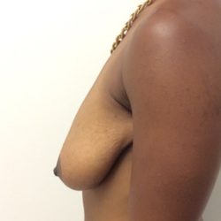 After Weight Loss Before & After Patient #2427