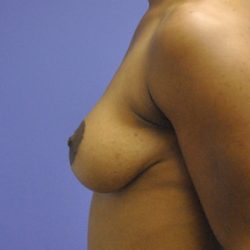 After Weight Loss Before & After Patient #2427
