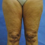Thigh Lift Before & After Patient #2447