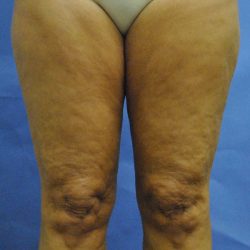 Thigh Lift Before & After Patient #2447