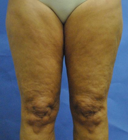 Thigh Lift Before & After Patient #2447
