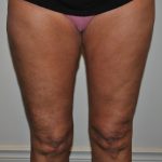 Thigh Lift Before & After Patient #2447