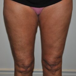 Thigh Lift Before & After Patient #2447