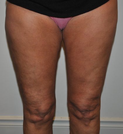 Thigh Lift Before & After Patient #2447
