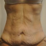 Body Lift Before & After Patient #2423