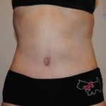 Body Lift Before & After Patient #2423