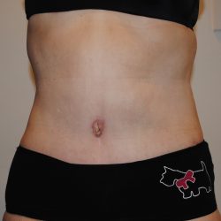 Body Lift Before & After Patient #2423