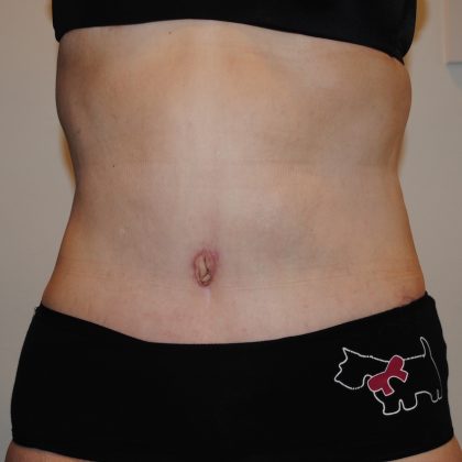 Body Lift Before & After Patient #2423